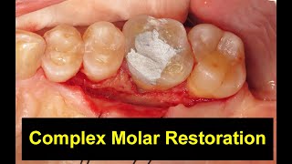 Misdiagnosed Molar Case [upl. by Aday]