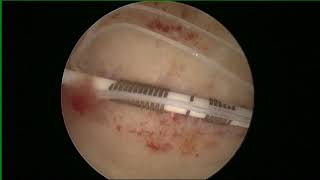 HYSTERSCOPIC Copper T removal [upl. by Alarise]