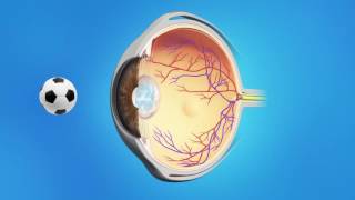 FOR Patients  Post Cataract Surgery YAG Capsulotomy explained in English [upl. by Annairoc626]