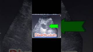 DIVERTICULA BLADDER  U bladder Stone  Cystitis  Residual Urine PMRV ultrasound [upl. by Ingraham]