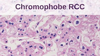 Chromophobe Renal Cell Carcinoma [upl. by Alverta]