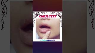 Cheilitis disease doctor nursing mbbs ytshorts education ssc song newsong [upl. by Akihsal]