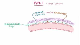 Membranoproliferative glomerulonephritis MPGN causes symptoms amp pathology [upl. by Charpentier]