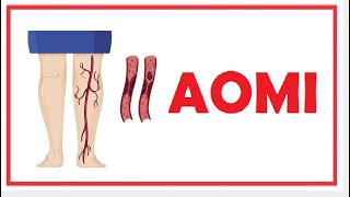 AOMI arteriopathie obliterante des membre inferieure [upl. by Nnahsal]