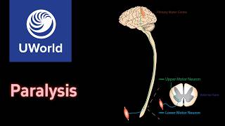 Vertebral malalignment amp Subluxation atlantoaxial joint  USMLE Step 1 UWorld Questions Neurology [upl. by Aisan245]