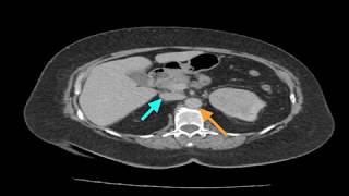 Clinical Case Renal Cell Carcinoma [upl. by Genesia780]