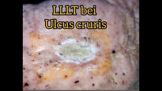 Ulcus Cruris Behandlung mit LLLT  HELBO Minilaser 3120 Anleitung Ulcus mit Laser behandeln [upl. by Essilevi683]