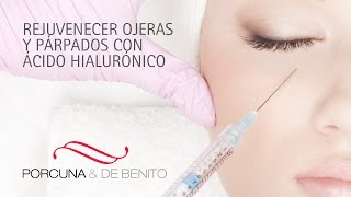 Rejuvenecer ojeras y párpados con ácido hialurónico [upl. by Parrish]