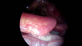 carcinoma Base of Tongue [upl. by Shelli]