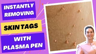 Plasma Fibroblast Treatment Say Goodbye To Skin Tags [upl. by Kirenoj]