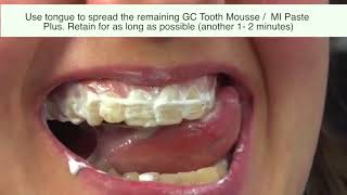 2 Methods to Use GC Tooth Mousse I Tooth Mousse Plus I MI Paste [upl. by Fran]