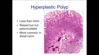 Hyperplastic Polyps Not Always What They Seem [upl. by Fredi]