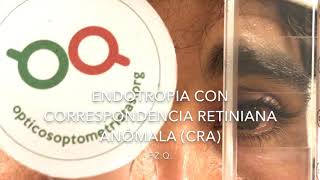 Endotropia con correspondencia retiniana anómala [upl. by Flatto833]