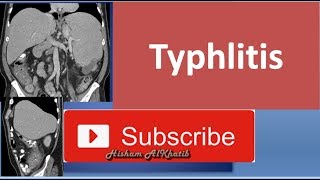 Typhlitis [upl. by Mendive]