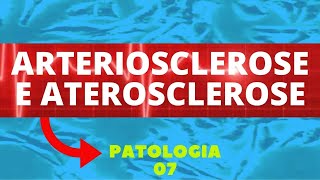 ARTERIOSCLEROSE E ATEROSCLEROSE  PATOLOGIA  AULA 7 [upl. by Friedman219]