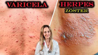 VARICELA  HERPES ZÓSTER Culebrilla SÍNTOMAS DIAGNÓSTICO Y TRATAMIENTO  Dra Aperpin [upl. by Yllatan]