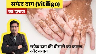 Vitiligo Disease  Cause And Treatment Explained  सफेद दाग का इलाज [upl. by Merriott]