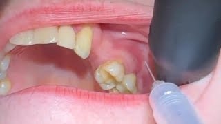 Local anesthesia for Extraction Maxillary molars [upl. by Asirrom183]