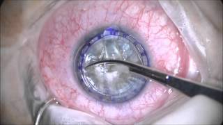 Deep Anterior Lamellar Keratoplasty [upl. by Edialeda]