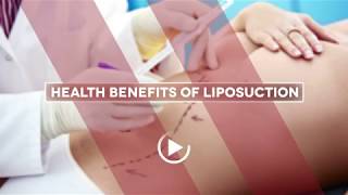 Health Benefits of Liposuction  Houston Plastic Surgery [upl. by Asetal807]