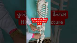 कुल्हे की हड्डी का फ्रैक्चर  Hip Joint Fracture  Femur Bone shorts viral youtubeshorts [upl. by Doowrehs618]