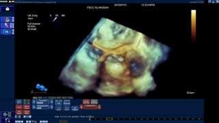 How to assess the Aortic root dimensions by 3DTEE Qlab [upl. by Mccreery34]