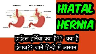 Hiatal hernia symptoms diagnosis amp treatment in hindi [upl. by Concoff147]