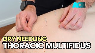 Dry Needling Thoracic Multifidus [upl. by Inaffets]