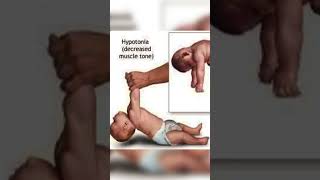 hypotonia baby parenting trending memes youtubeshorts shortsfeed [upl. by Fabrianne356]