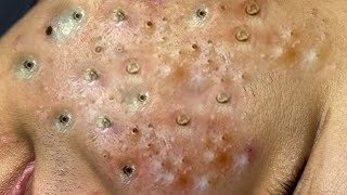 Blackheads Removal  Acne Treatment and Very Satisfying Satisfying Pimple pop blackheads [upl. by Bryanty874]