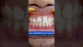 Got a BROKEN Front tooth Repair it today Dr Srishti Bhatia smilemakeover [upl. by Gambell]