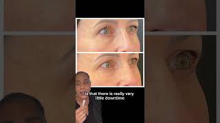 The best treatment to treat aging eyes [upl. by Ahtiekahs]