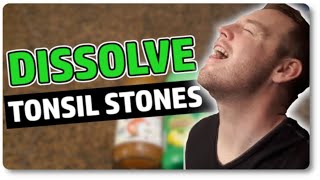 Dissolve Tonsil Stones At Home With Only 3 Ingredients [upl. by Rai489]