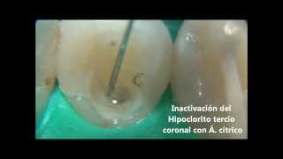 Calentar el hipoclorito de sodio irrigación en endodoncia [upl. by Braunstein168]