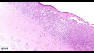 Skin Melanoma Microscopy  Talking slide [upl. by Crispas715]