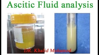 Ascitic fluid analysis تحليل السائل البريتوني [upl. by Apgar]