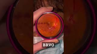 Branch Retinal Vein Occlusion eyes ophthalmology optometry [upl. by Kenley135]