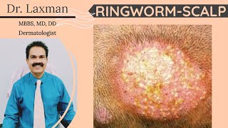 Tinea Capitis  Fungal Infection Of Scalp  Scalp Ringworm  Hair Fungus  Kerion  Black Dot [upl. by Katya]