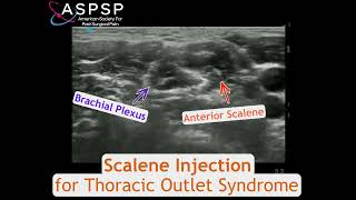 Scalene Injection for Thoracic Outlet Syndrome [upl. by Elsworth]