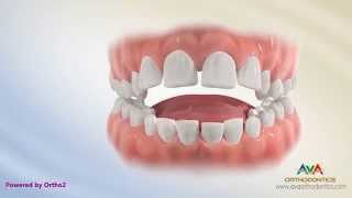 Orthodontic Treatment for Tongue Thrusting Habit  Different Options [upl. by Juana836]