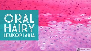 Oral Hairy LeukoplakiaExplained by a Dermatopathologist [upl. by Strohl584]