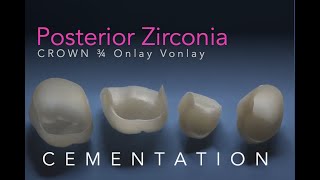 Zirconia Ceramics Part 5 Posterior Onlay 34 Vonlay and Crown Cementation [upl. by Ecenahs454]