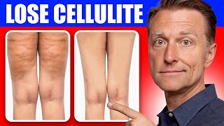 Get Rid of Cellulite for Good Dr Bergs Better Way to Lose Flabby Fat [upl. by Caffrey758]