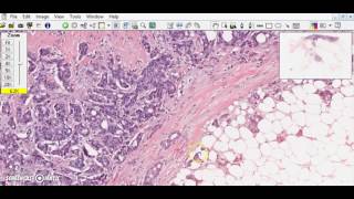 Breast ductal carcinoma Breast cancer [upl. by Frydman]