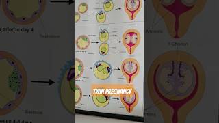 dizygotic and monozygotic definition for TWINS Pregnancy 😳😍 [upl. by Tiraj]