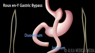 Roux enY Gastric Bypass with Introduction on Body Mass Index Animation [upl. by Thorbert]