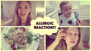 Allergic Reaction  What I Ate Wednesday [upl. by Eugene]