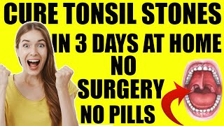 Tonsil Stones Treatment Removal At Home  Get Rid Of Tonsil Stones In JUST 3 Days FOREVER [upl. by Adrahc321]