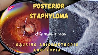 Posterior Staphyloma Causing Myopic Anisometropic Amblyopia [upl. by Snehpets]