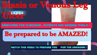 Venous Leg Ulcer Stasis Ulcer  Understanding the cause  treatment and selfmanagement [upl. by Wira]